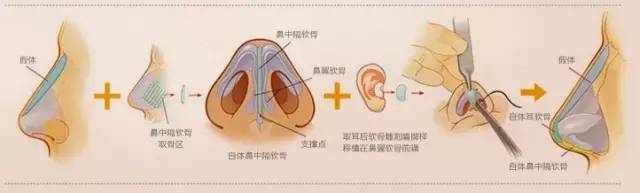 鼻梁翘，颜值爆！