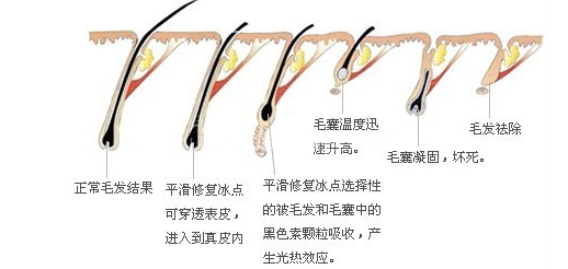 冰点脱毛原理图