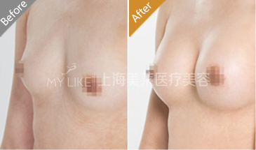 自体脂肪丰胸案例对比