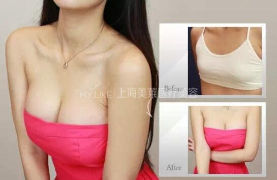 哪家丰胸好 如何正确选择