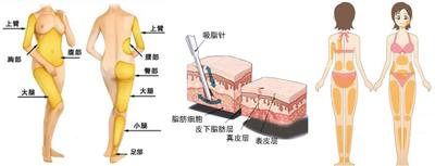 吸脂减肥那些事