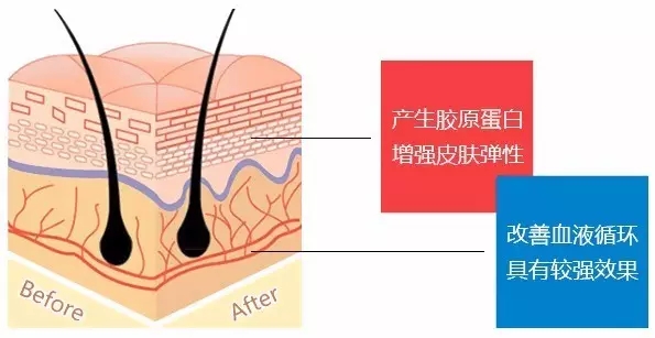 线雕提升除皱的优势是什么