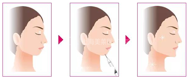 微整形,专治面部五官各种“不服”