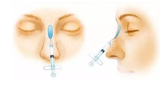 微整形,专治面部五官各种“不服”