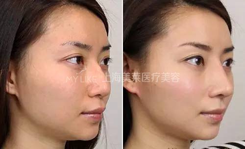 鼻梁翘，颜值爆！