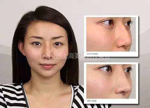 鼻梁翘，颜值爆！