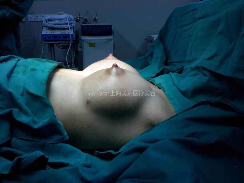 适合才较美,假体丰胸、自体脂肪丰胸大pk <wbr>看看哪种适合你?