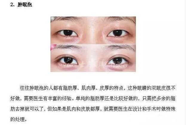 跟单眼皮道别,让双眼皮帮你解决八大眼部问题