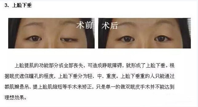 跟单眼皮道别,让双眼皮帮你解决八大眼部问题