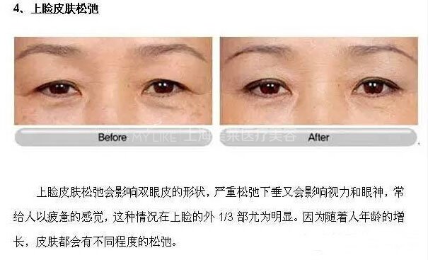 跟单眼皮道别,让双眼皮帮你解决八大眼部问题