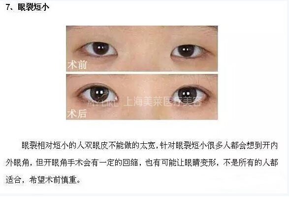 跟单眼皮道别,让双眼皮帮你解决八大眼部问题