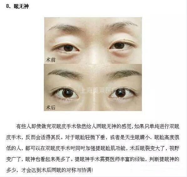 跟单眼皮道别,让双眼皮帮你解决八大眼部问题